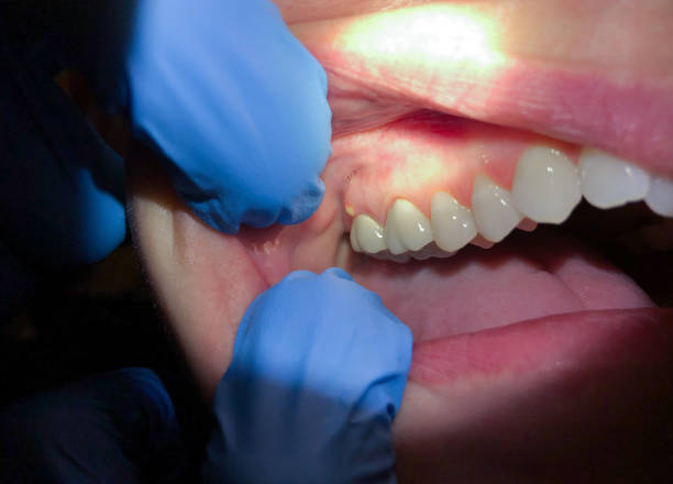 Best Emergency Dental Care for Abscessed Tooth in Aspermont, TX