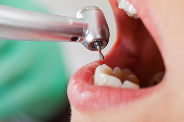 Best Emergency Dentist for Lost Fillings or Crowns in Aspermont, TX